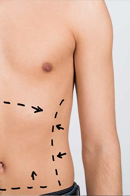 medicalbeautyspa-health-and-beauty-fett-absaugen-ohne-op5